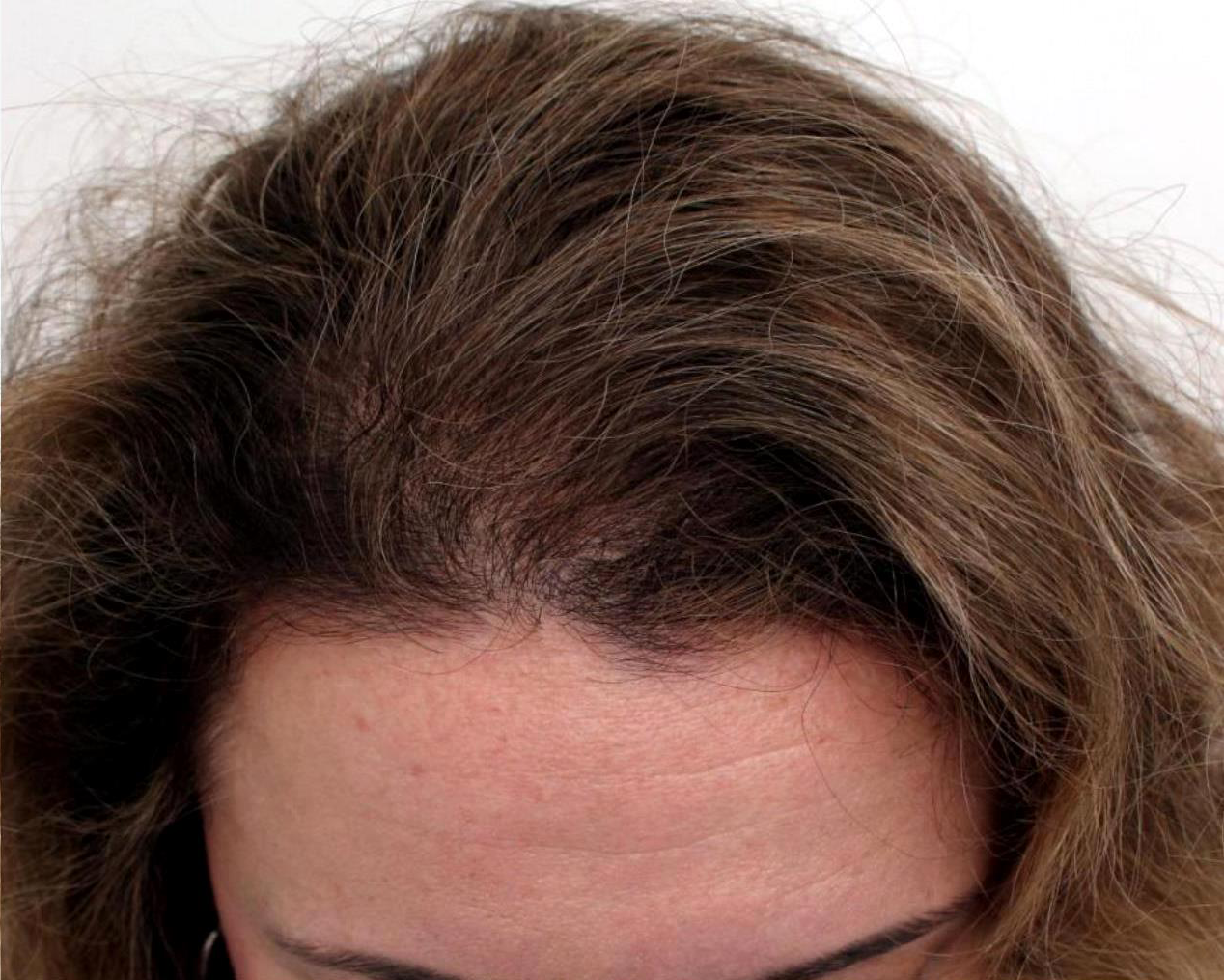 Jennifer M. after 3 months using Better Hair Box